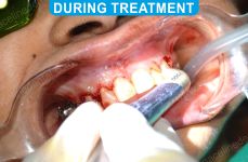 Laser Dentistry 2-3