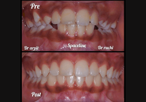 aligner-2