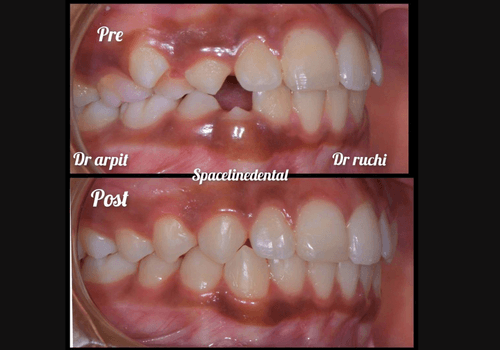 aligner-3