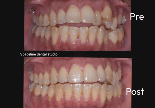aligner-4