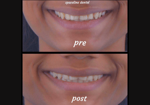 aligner-5