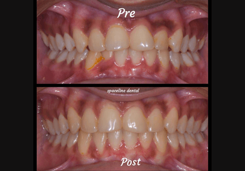 aligner-6