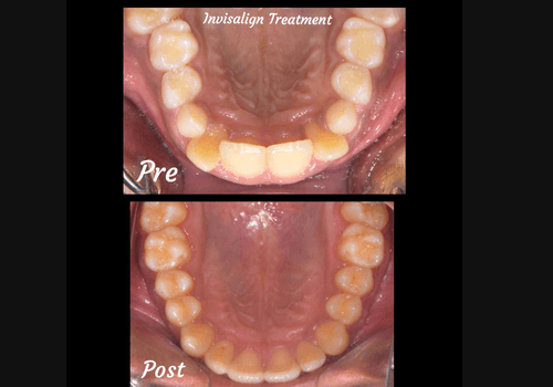 aligner-7