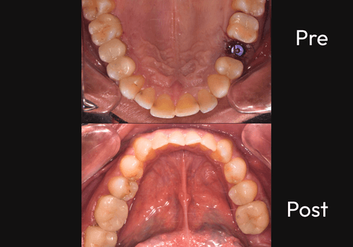 cerac-1