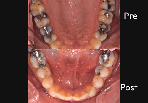cerac-2