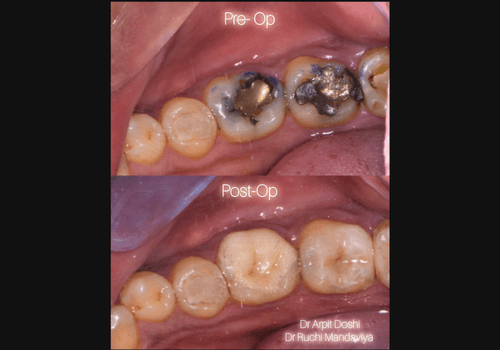 cerac-4