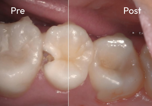 cerec-case-2