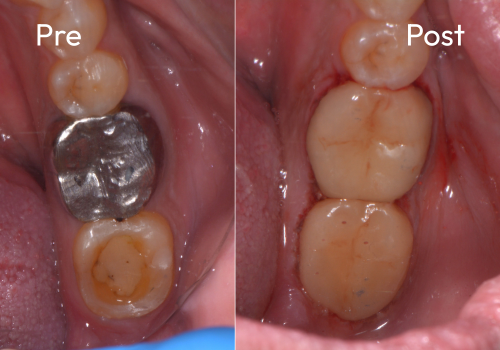 cerec-case-3