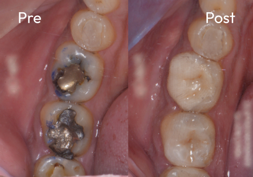 cerec-case-4