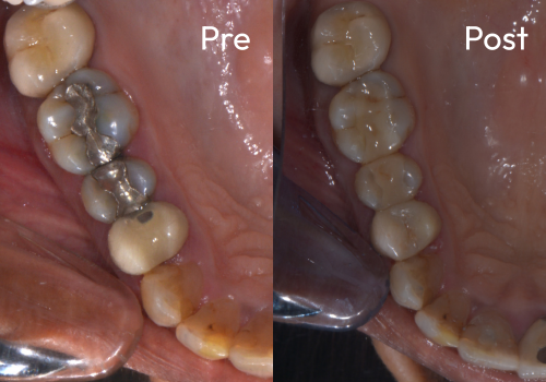 cerec-case