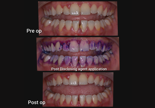 gbt-1
