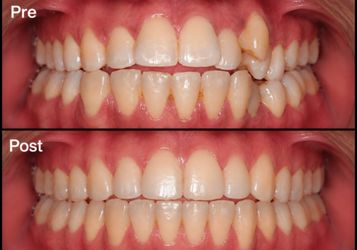aligners