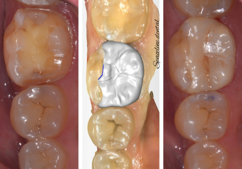 cerec-5