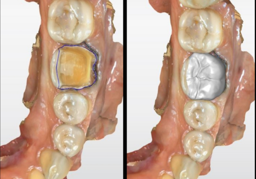 cerec-6