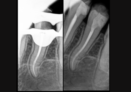 endo-2