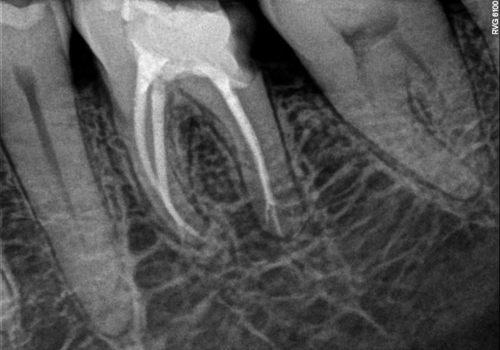 endo-3