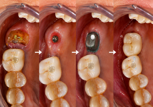 implant-1