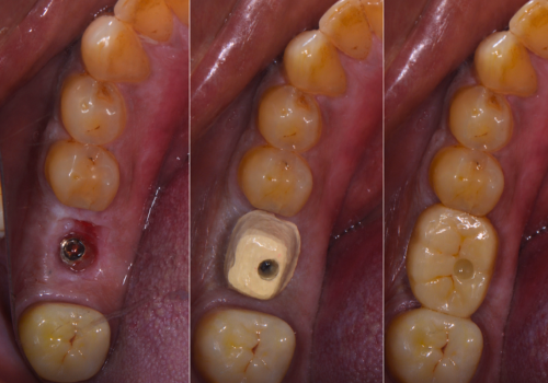 implant-2