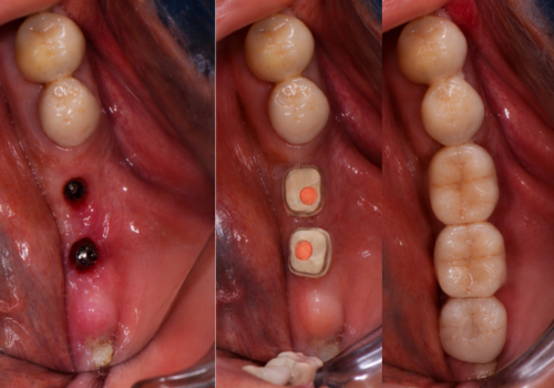implant-3