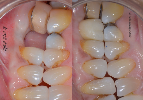 implant-6