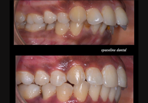 invisline-2