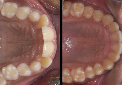 invisline-4